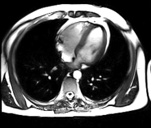 220px-Beating_Heart_axial.gif